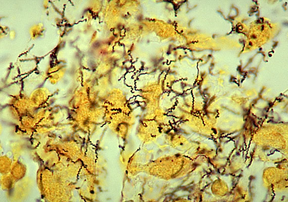 Here is a close-up of the germ that causes syphilis infections. It first makes itself visible through sores that appear on genitals and other parts of the body. (FILE PHOTO)