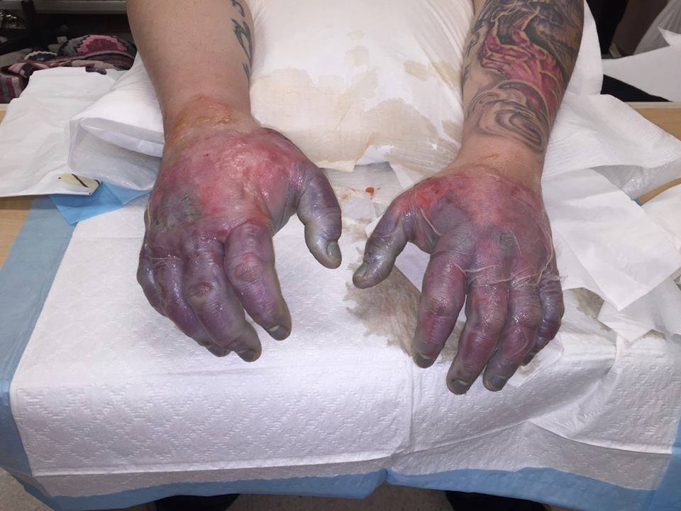 This how Romeo Tucci's hands looked when he first arrived at the health centre in Cambridge Bay. (PHOTO COURTESY OF C. TUCCI)